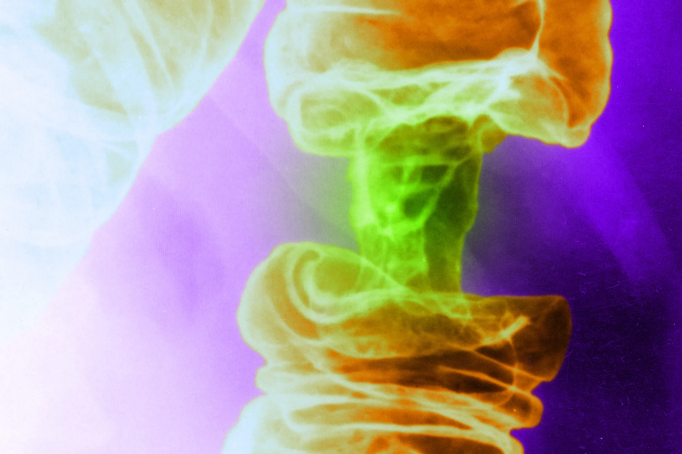 Un nuevo tratamiento contra el cáncer basado en la luz destruye las células tumorales y respeta las sanas.